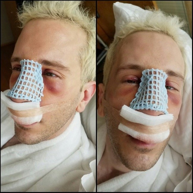 ElkY nach der OP elky nose job2
